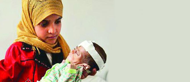 Yemen'de 10 milyon kişi açlıktan ölmek üzere