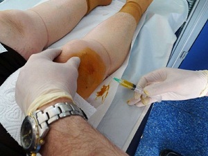 Diz kireçlenmesinde yeni umut PRP