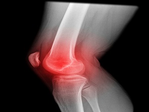 Diz Ağrısında Yeni Teknik