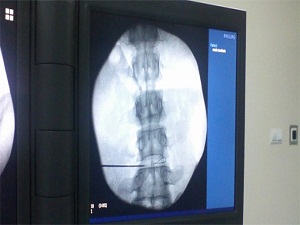 Bel fıtığını ameliyatsız tedavi ediliyorlar