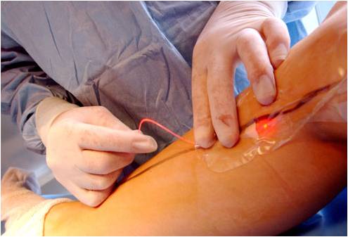 Lazerli varis tedavisinde hasta normal hayata çabuk dönüyor