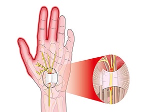 Sinir sıkışıklığının sebebi sadece mesleğiniz olmayabilir