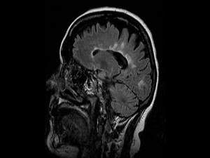 MS'te yeni çığır!