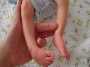 Çarpık ayak erken dönemde ameliyatsız tedavi edilebiliyor