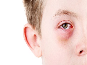 Gözü çapaklananlar dikkat!