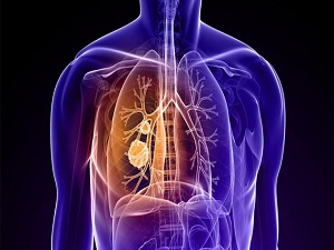 Uzmanlardan 'KOAH' uyarısı!