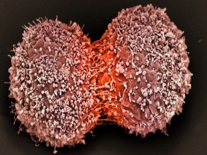 3 kanser vakasından birisi önlenebilir