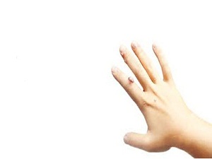 Lazerle siğil tedavisi