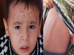 Bu hastalığa çare bulunamıyor!