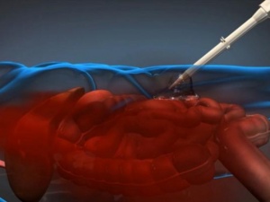 İç kanamayı kontrol eden köpük