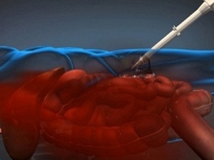 İç kanamaları azaltan köpük