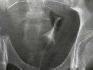 Bu kemiğin kırılması öldürebilir