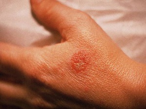 Egzama tedavisinde altın tavsiyeler