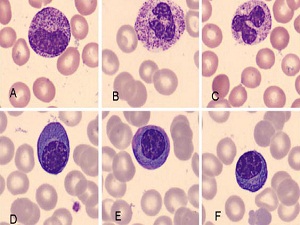 Miyelom tedavisinde umut verici gelişmeler