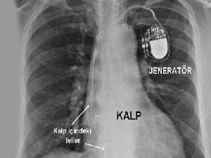 MR uyumlu kalp pilleri avantajlı