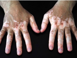 Vitiligo tedavisinde umut ışığı