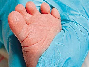 10 yılda talasemili bebek sayısı 20’nin altına düştü