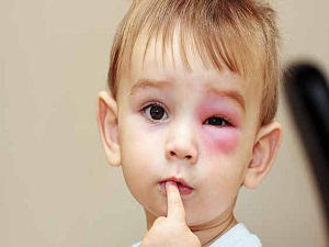 Çocuğunuzun gözü sık sık şişiyor mu?