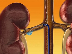 Dirençli tansiyona 'renal denervasyon' umudu