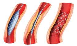 Her krize stent olmaz