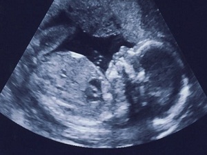 Kalıtsal hastalıklar anne karnında tespit ediliyor