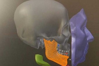 Vücudun tüm kemiklerinin protezini ürettiler