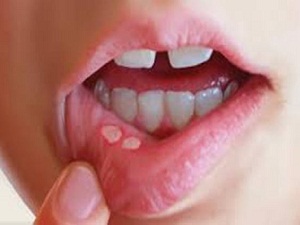 Ağızda çıkan küçük yaraları önemseyin!