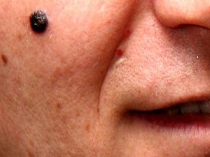 Her ben, kanser değildir