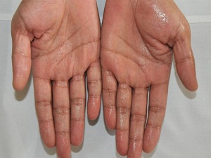 Yoğun terleme ve ateş lenforma belirtisi olabilir'