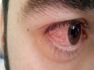 Göz kanlanmasını basite almayın