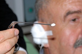 Sigara kağıdıyla kulak zarı tedavisi