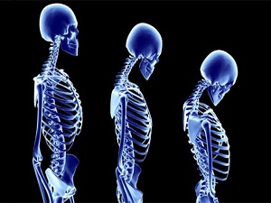 Boy kısalması kemik erimesi belirtisi olabilir