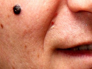 Benler kanser habercisi olabilir