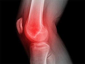 Çocuklardaki diz ağrılarını hafife almayın