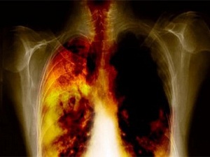 Türkiye’de 5 Milyon Koah’lı Hasta Bulunuyor