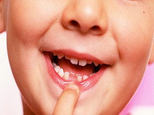 Erken kaybedilen sütdişi ağız yapısını bozuyor