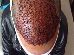 Saç ekiminde 'merdiven altı' uyarısı