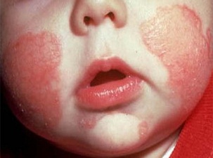 Bebeklerde 1 yaşına kadar egzama görülebilir