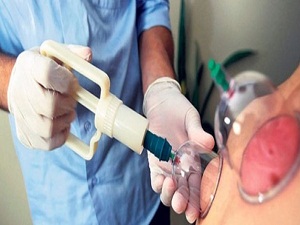 Hoşgeldin tıbbi hacamat