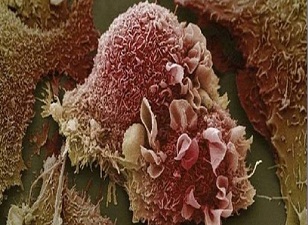 Kanser, dünya genelinde artıyor!