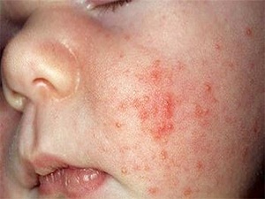 Çocuklarda alerjik egzama uykusuzluğa neden olabilir