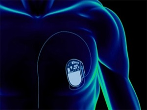 Kalp pili taşıyanlar manyetik alanlardan uzak dursun!