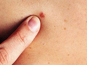 Deri kanseri tespiti için ücretsiz tarama yapılacak, kaçırmayın!