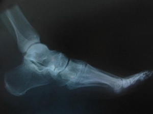 Kırıkların tedavisinde ipek vidalar kullanıldı