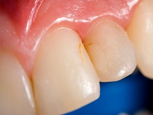 100 çocuktan 98’inin dişleri çürüyor