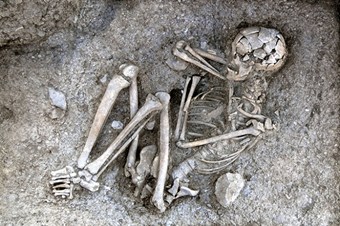 Kanser 3200 yıl önce de vardı