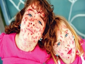 Kanada'daki Kızamık Salgını ABD'ye de Sıçradı