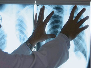 Türkiye’deki 2 bin 200 verem hastası kayıtsız!