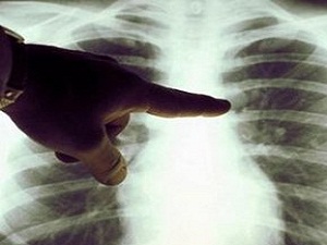 Akciğer kanserinde tedavi başarısı 3 kat artıyor