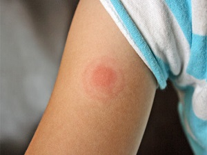 Sinsi lyme hastalığına dikkat!